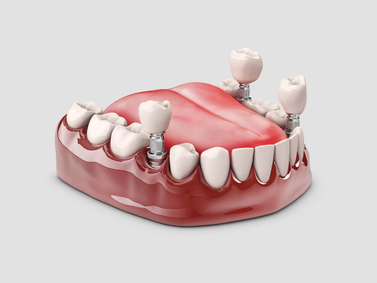 human-teeth-dental-implant-3d-illustration