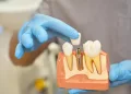 plastic-prop-teeth-implant-being-shown-by-dentist