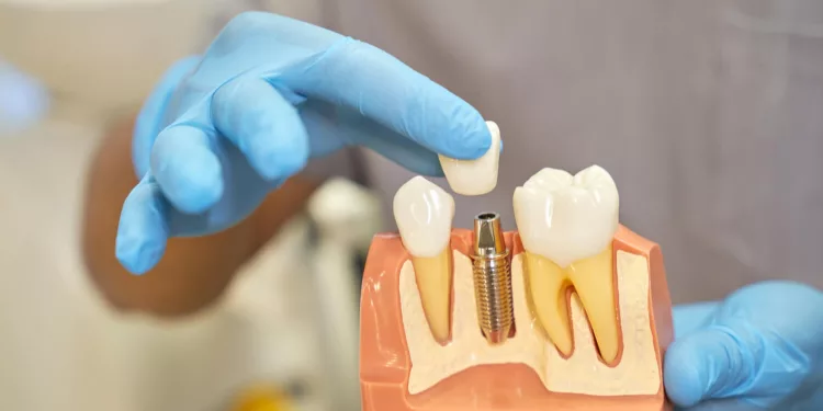 plastic-prop-teeth-implant-being-shown-by-dentist